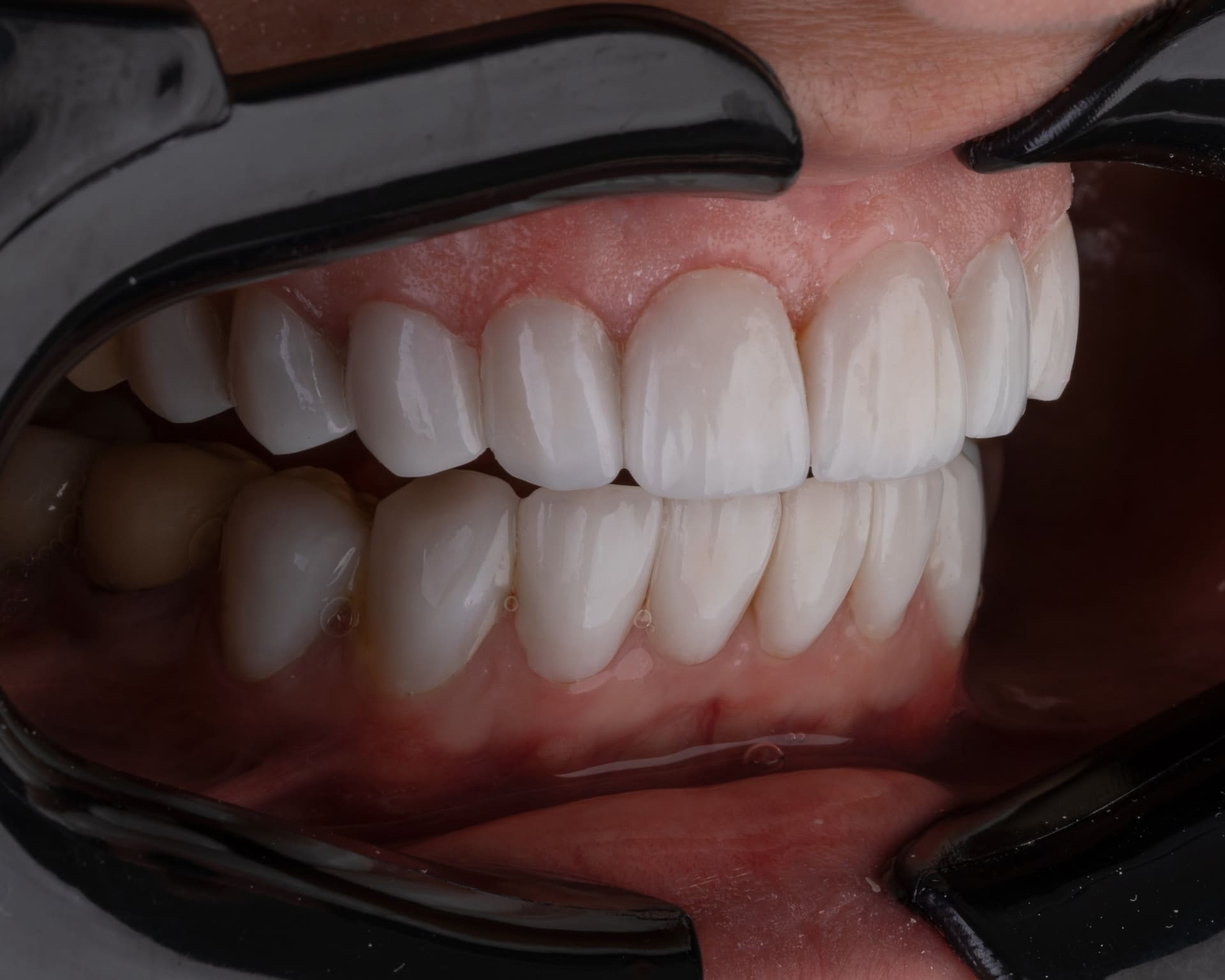 Close-up of mouth during dental veneers procedure