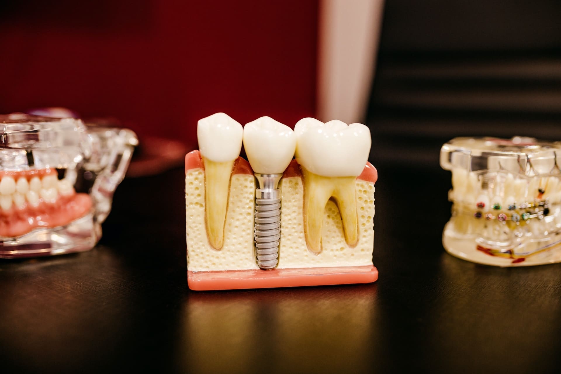 Model displaying dental implant on table